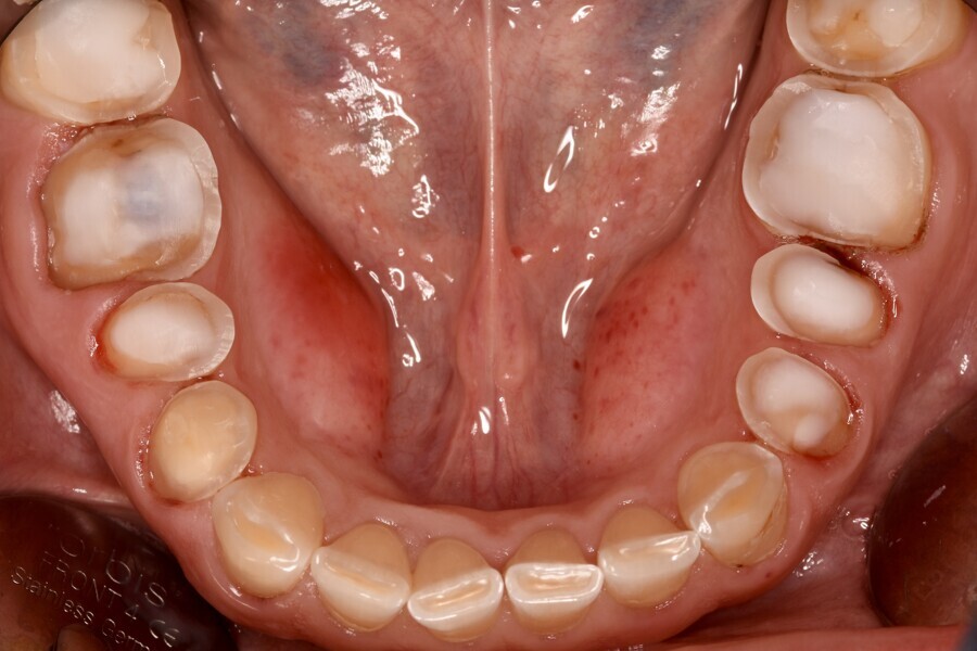 Fig. 6b: Tooth preparation in the lower jaw.