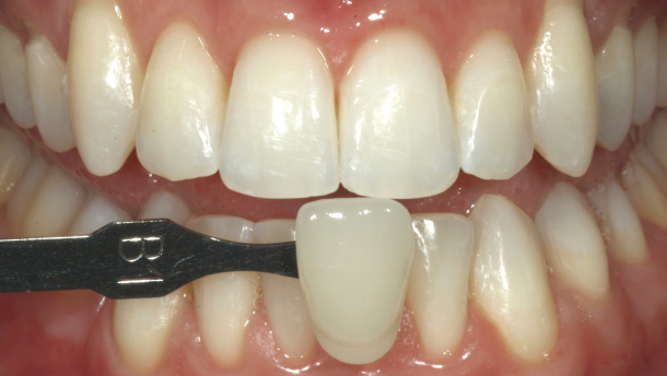 Técnica de aclaramiento dental en el consultorio