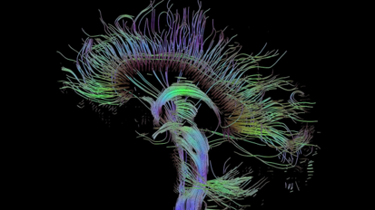 Stamcellen uit tanden kunnen veranderen in hersencellen