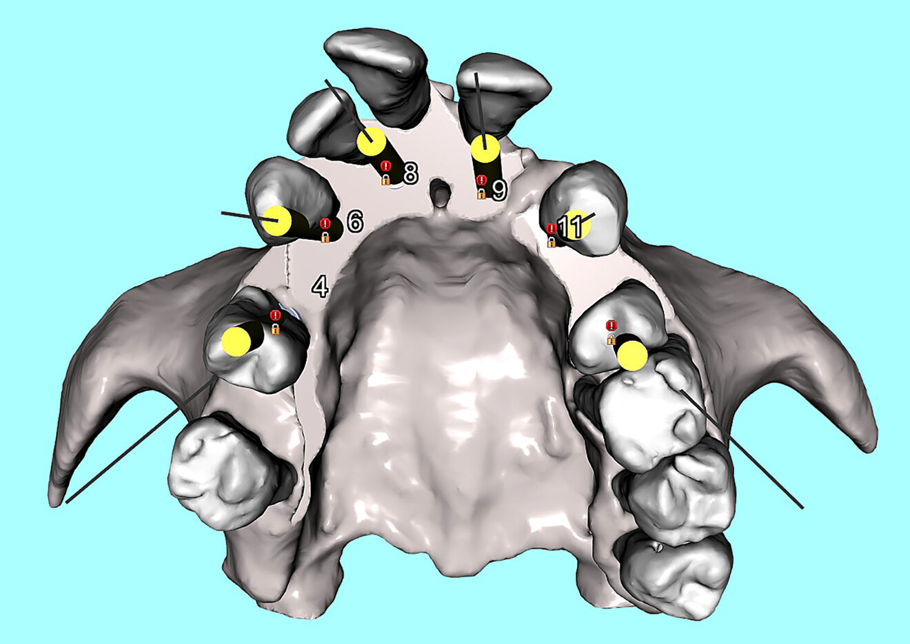 Fig. 4b: Occlusal view of the simulated implants with yellow abutment projections to show the trajectory of the screw access holes.