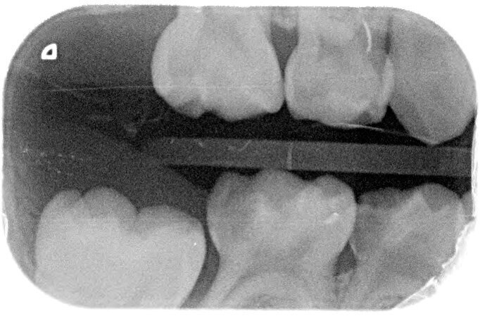 Afbeelding 4a. Bitewings na 3 jaar. Laesie 74 distaal wordt beslepen.