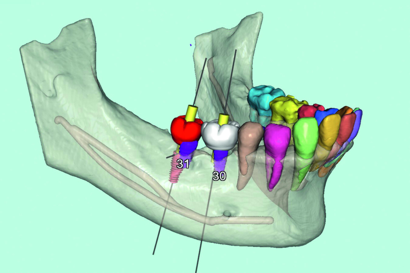 Fig. 2 : La segmentation avancée des dents et de l’os, pilotée par l’intelligence artificielle, combinée à la transparence sélective et à l’intégration de dents virtuelles sur des implants simulés, facilite une planification guidée par la restauration.
