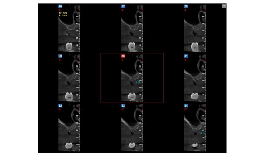 Fig. 3_CBCT per valutare esecuzione del rialzo di seno mascellare con approccio laterale.