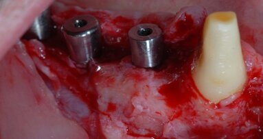 Valutazione clinica di un dispositivo riassorbibile “a cupola”, associato a GBR