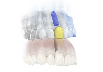 Dentsply Sirona – SIMPLANT e ATLANTIS