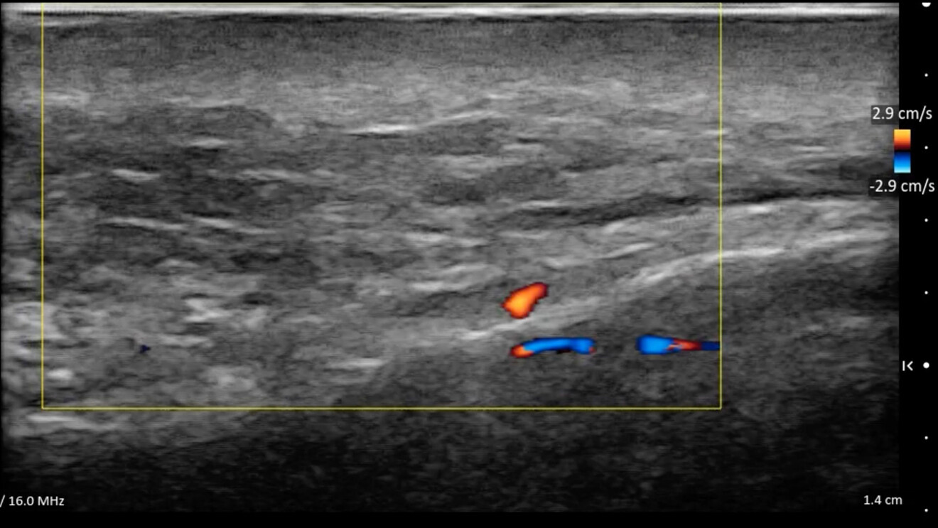 Fig. 9 - L’arteria angolare in Color Doppler.
