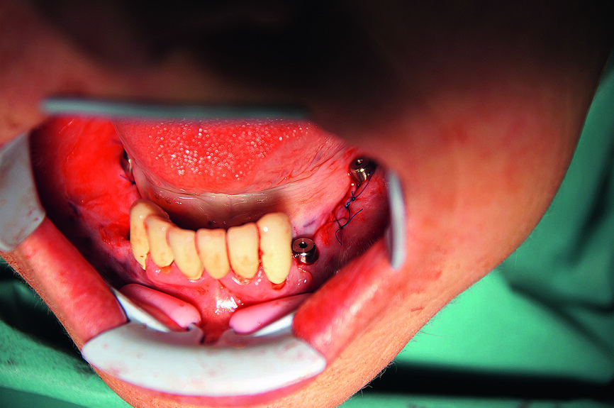 Fig. 10 : Tous les implants guidés in situ avec façonneurs gingivaux.