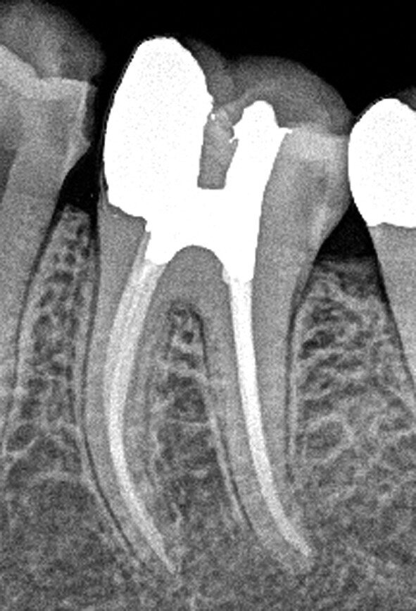 Fig. 5 : Radiographie postopératoire d’une molaire inférieure traitée au travers de la lésion carieuse mésiale et d’un autre petit accès au niveau de la fosse centrale. La préservation de la dentine entre les points d’accès est appelée configuration d’accès en « ferme ». (Photo : fournie par le Dr John Khademi)