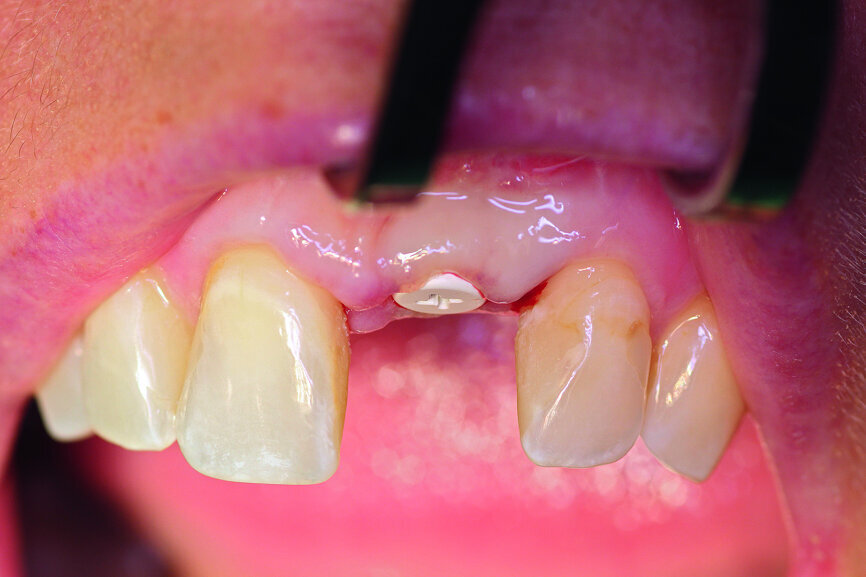Fig. 7: Implant exposure after another four months.