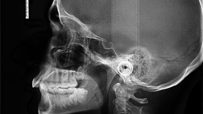 Widening the scope of aligner application: A case report