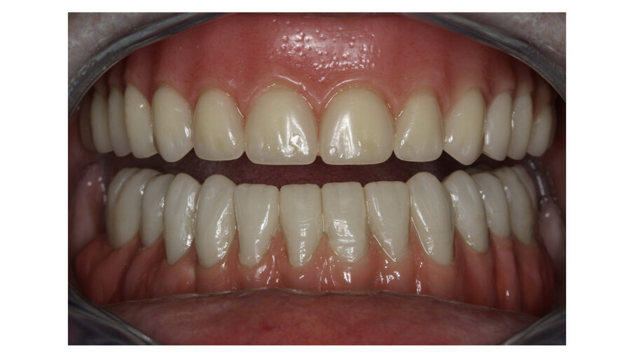 Fig. 18: Final case in the mouth of the patient. Wearing a complete denture on top and tele-copic BRILLIANT Crios on the lower jaw.