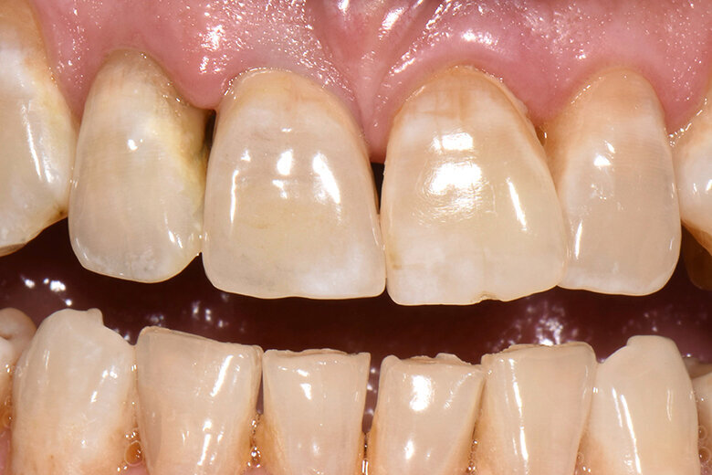 Fig. 6. Tras la colocación autoadhesiva de la corona terminada se observó una estética general armoniosa.