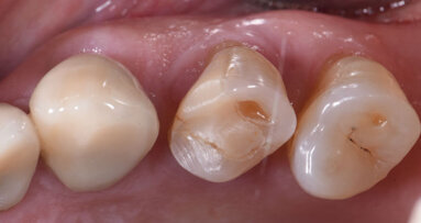 La customizzazione Cad-Cam delle cappette di guarigione negli impianti post-estrattivi