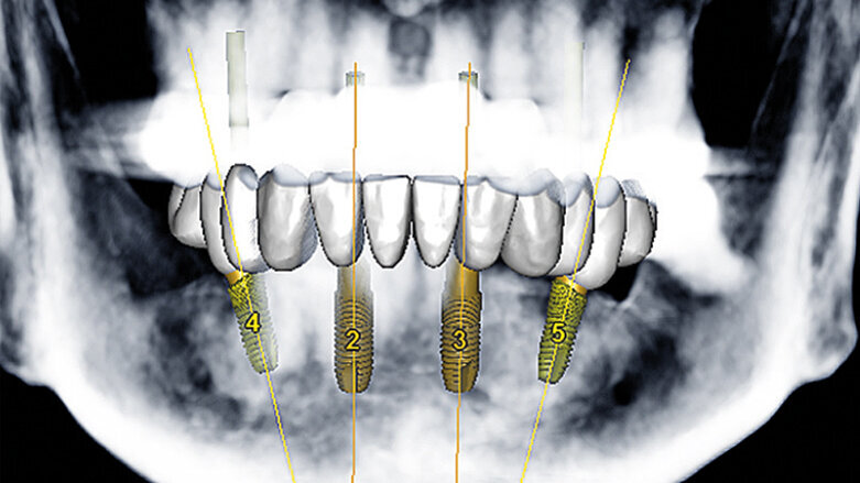 Rekonstrukce chrupu v dolní čelisti