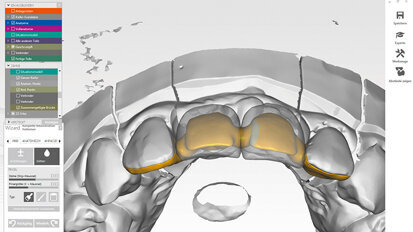 Estetická rehabilitace a zachovávání tkání ve frontálním úseku chrupu