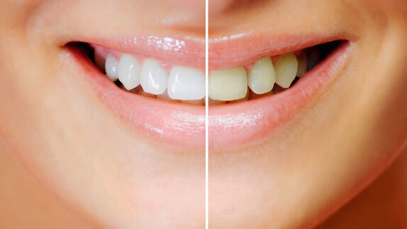 Le blanchiment ou l’éclaircissement des dents est désormais strictement réservé aux chirurgiens-dentistes
