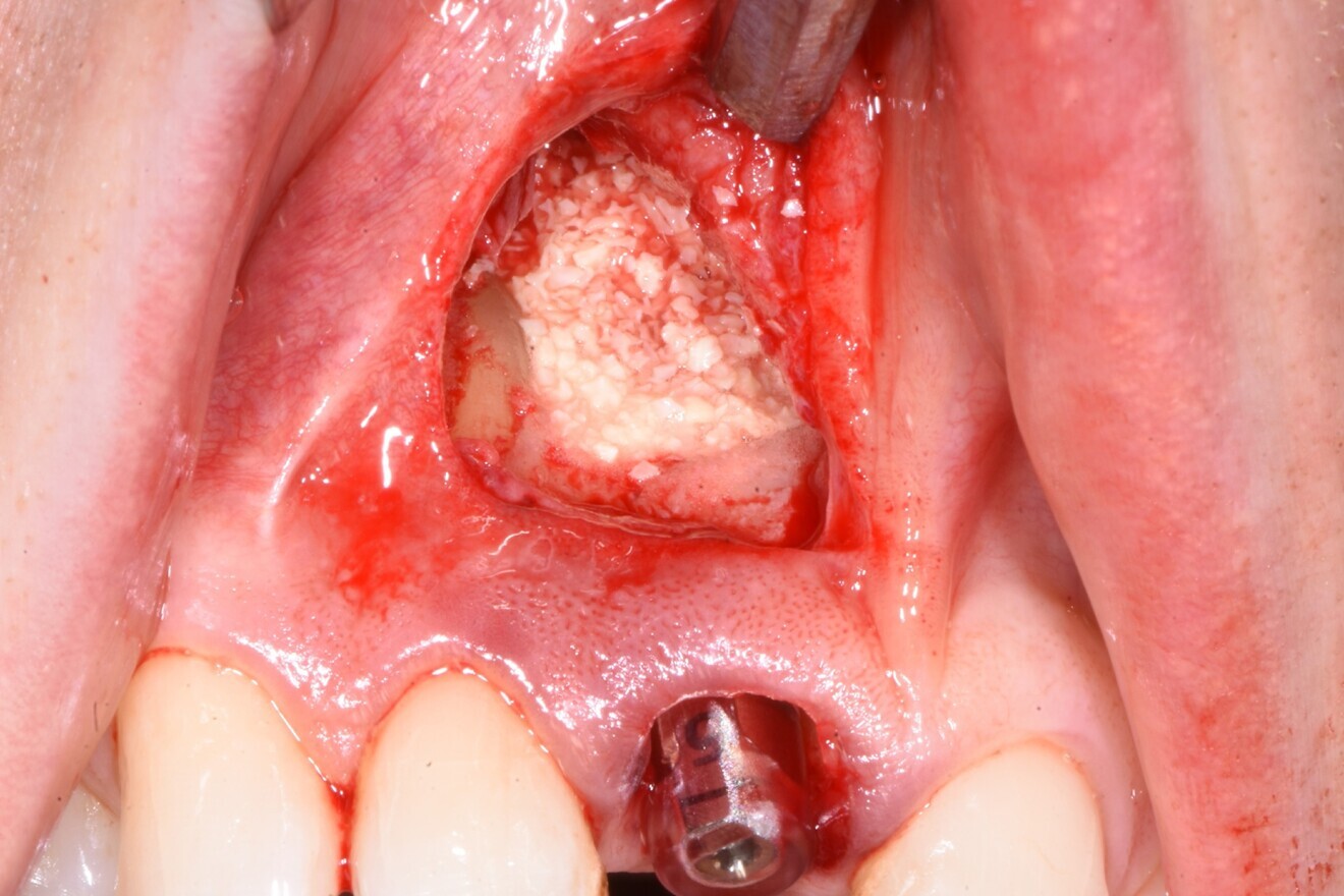Fig. 9: Infra-bony cavity grafted with a bovine bone mineral rehydrated in a tetracycline solution.