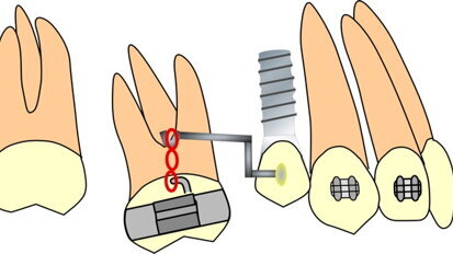 Biomechanics in the orthodontic treatment of complex multidisciplinary problems