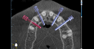 Fixní rekonstrukce celého oblouku nesená implantáty: Využití „full-template guidance technique