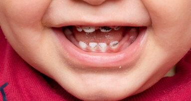 Silver diamine fluoride can arrest severe early childhood caries