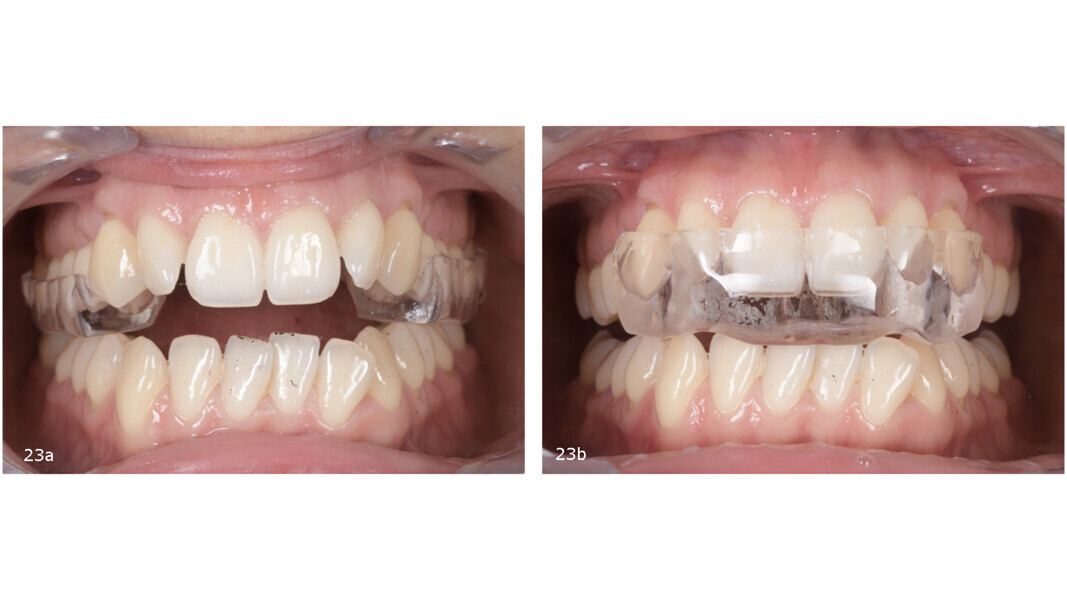 Figs. 23a & b: Two-piece FACE splint. Posterior segment (a). Anterior segment (b).