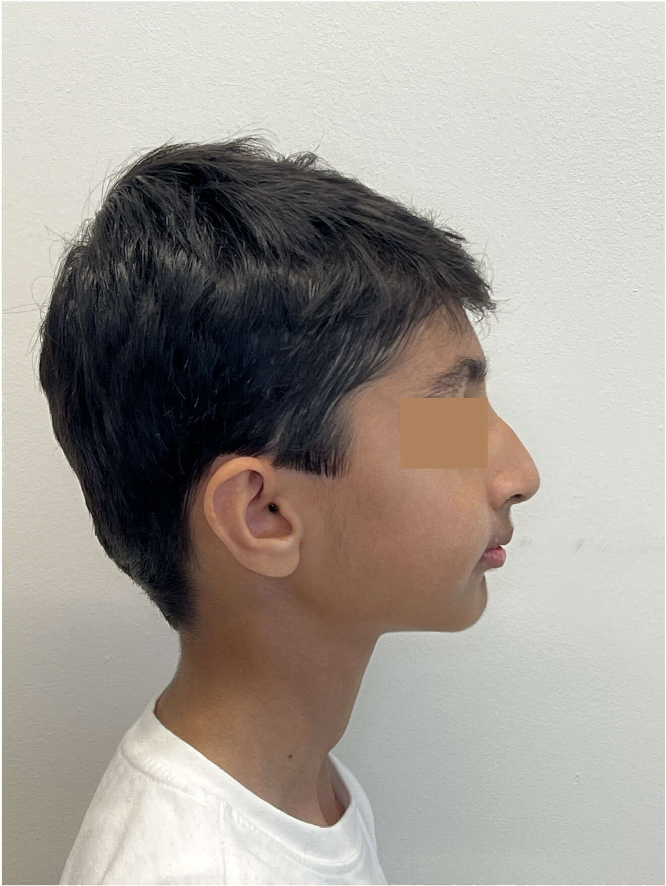 Figs. 1a–c: Pretreatment extra-oral photographs.