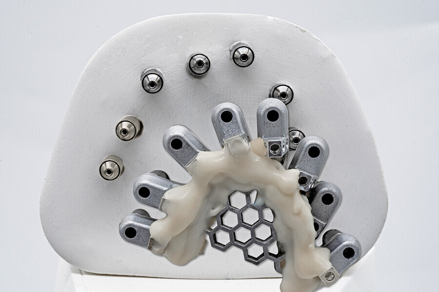 Fig. 5j: Model fabricated to test the fit of the OptiSplint and final restoration.