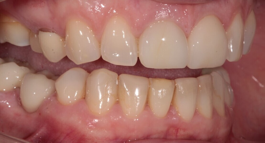 Fig. 10: 2017—the maxillary central incisor restorations still in place but the mandibular right central almost completely worn.