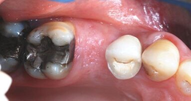 Alveolaire Ridge Preservation