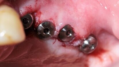 Zastosowania indywidualnej siatki tytanowej w augmentacji wyrostka zębodołowego szczęki z wykorzystaniem rhPDGF – część II