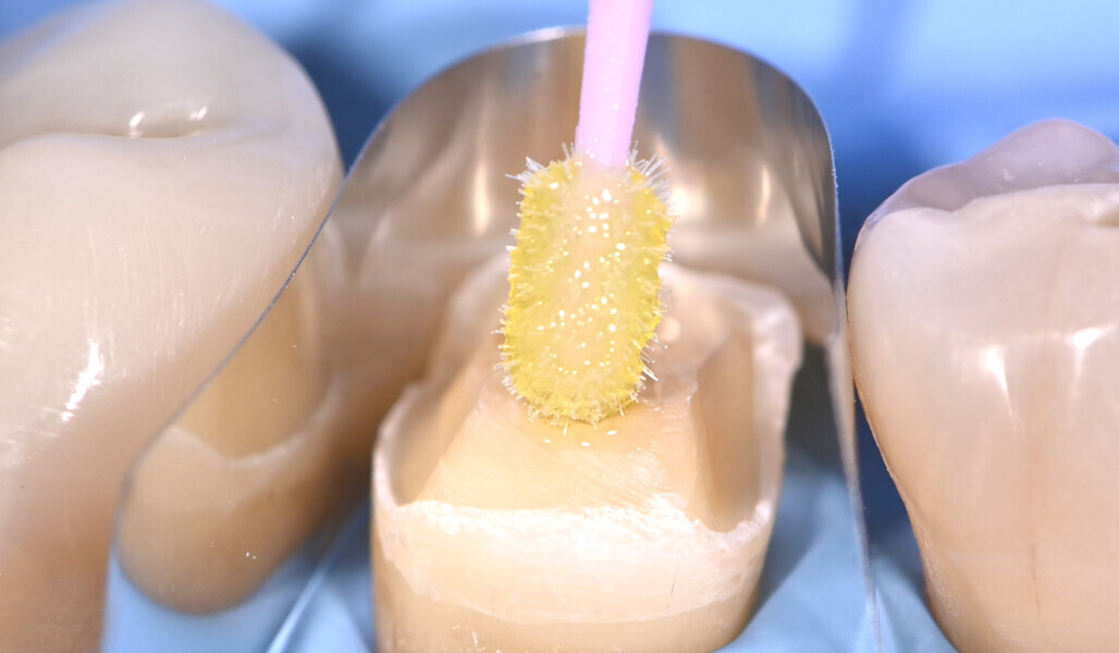 Fig. 4: Immediate dentinal sealing: application of the universal adhesive. 