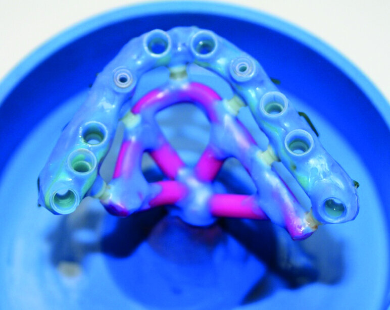 Fig. 5 : Cire d’armature : mise en évidence de 8 logettes receveurs pour le collage des bagues titane et de 2 coulées pour vissage direct implant. 
