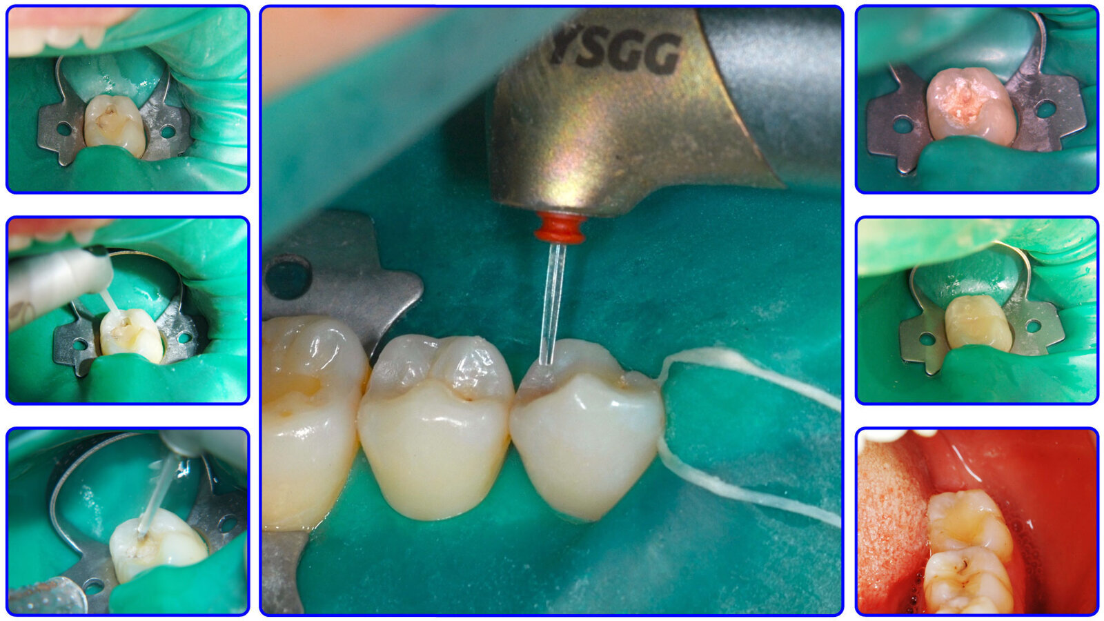 Láser en Odontología Conservadora (8)