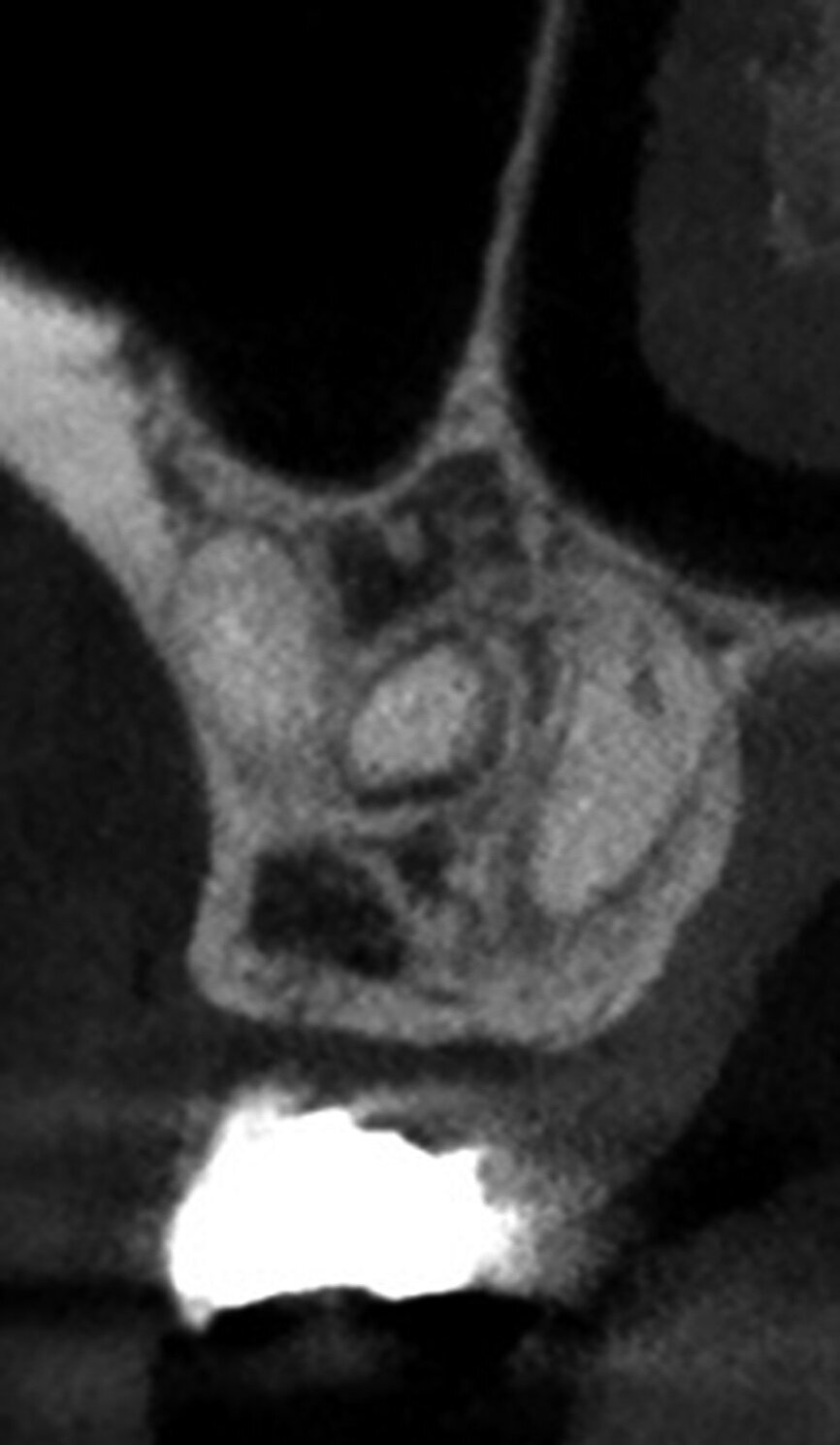 Figs. 4c: The imported scan can be reviewed in the axial (a), sagittal (b), and coronal (c) planes and the software presents a 3-D reconstruction view (d) where the transparency of the teeth
can be changed.