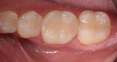 Nanohybrid composite solutions that patients love