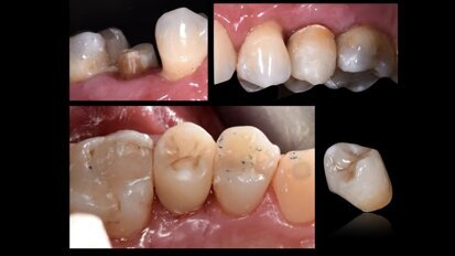 Un innovador poste radicular ayuda a preservar la sustancia dental