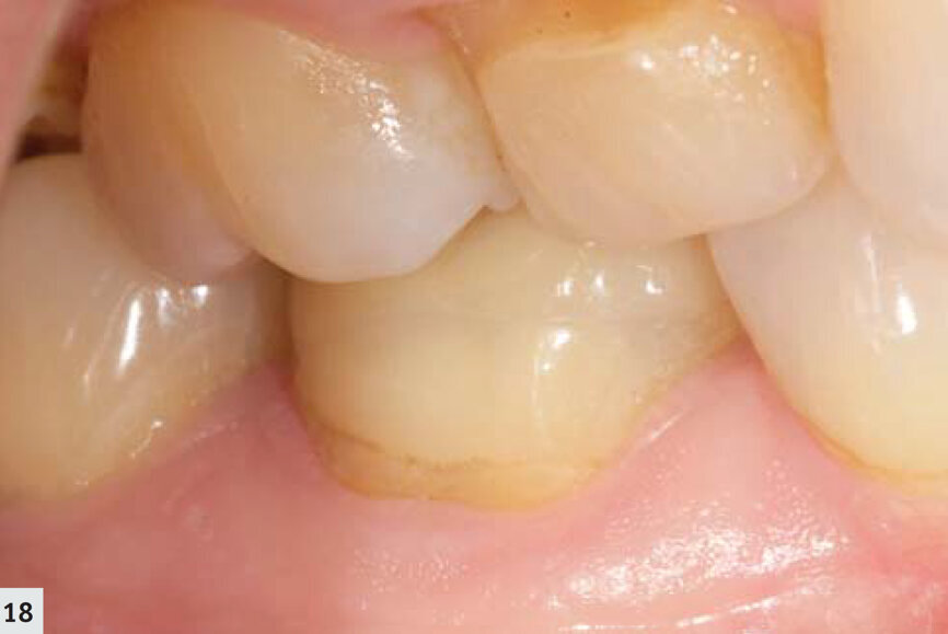 Fig. 18 : Suivi de l’onlay en disilicate de lithium, trois ans après sa mise en place.