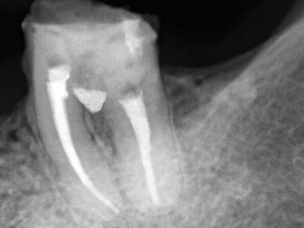 Fig. 7: Follow-up X-ray after two months.