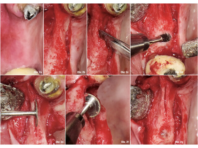 Preoperační situace - b: Stav po odklopení mukoperiostálního laloku - c: Perforace kompakty a počátek splittingu - d: Transkrestální přístup v oblasti zubu 16 - e, f: Splitting diamantovým diskem za stálého chlazení - g: Splitting v premolárové oblasti a transkrestální přístup do čelistní dutiny