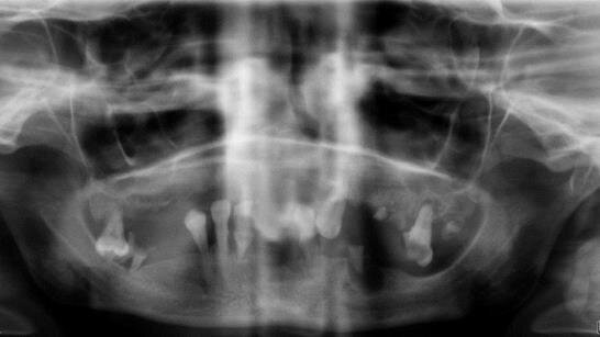 Atypowe powikłanie w leczeniu implantologicznym bezzębnej żuchwy