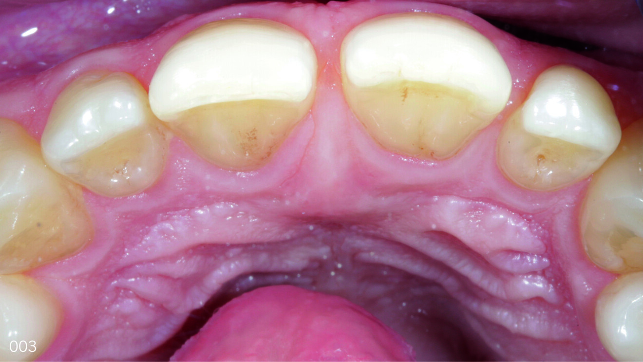 Fig. 3: Occlusal photograph of the anterior sextant.