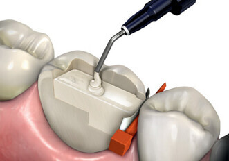 Heraeus & DenTrek announce new 3-D animated training module for Venus Bulk Fill