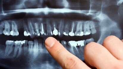 Stan zębów a zdrowie zatok