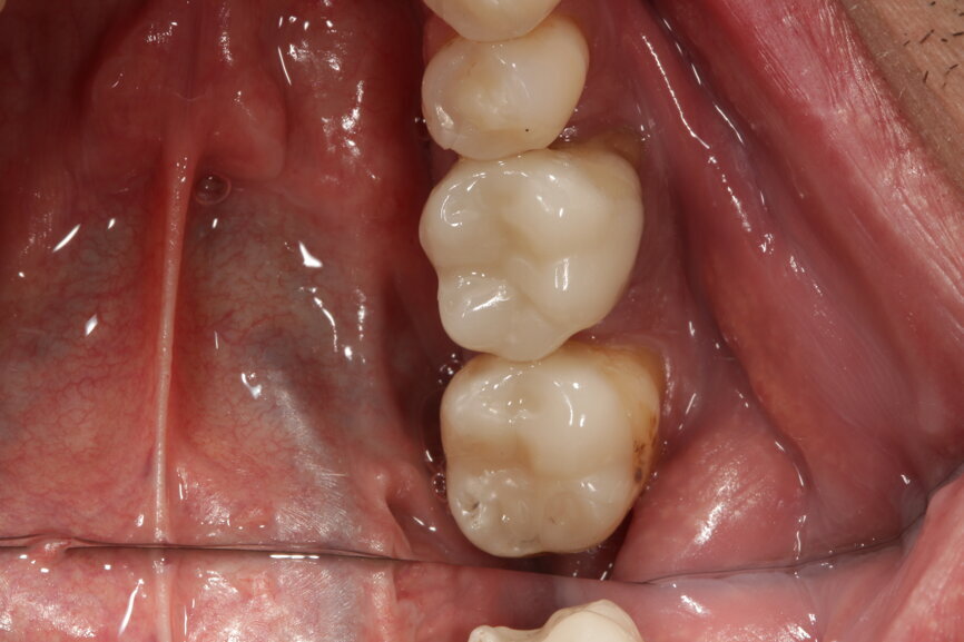 Fig. 9: Restorations inserted in the mandible.