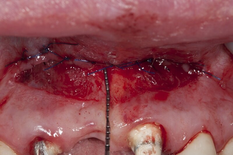 Ryc. 5_Zabieg westibuloplastyki.