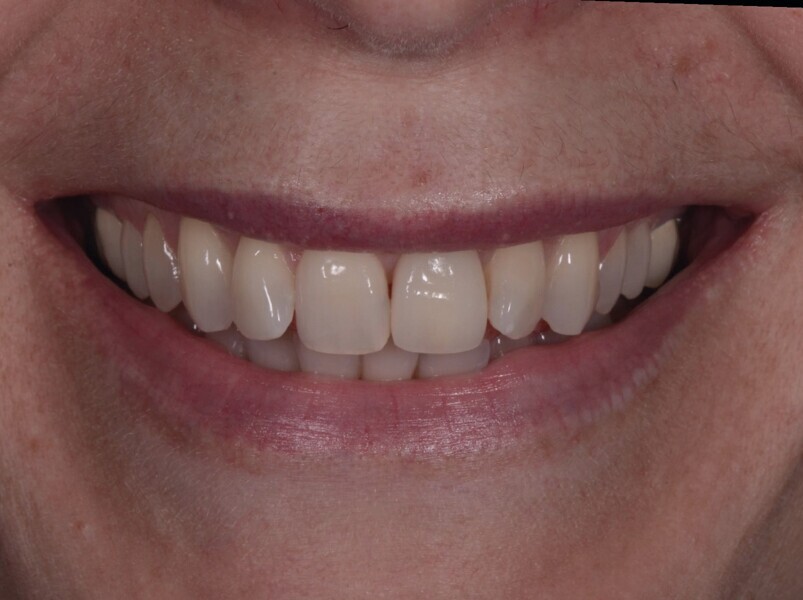 Fig. 21b : Sourire après le traitement.