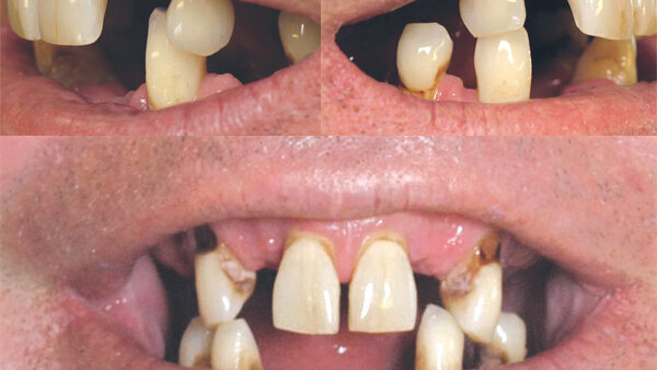 Una solución para cada arcada