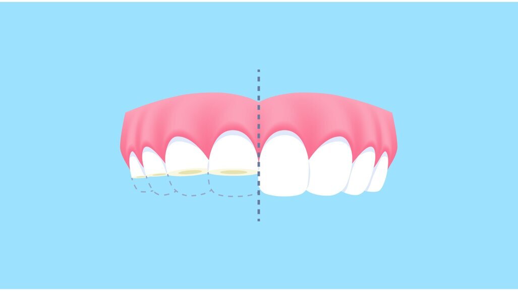 Nieuwe KIMO-richtlijn ‘Gebitsslijtage van blijvende elementen’
