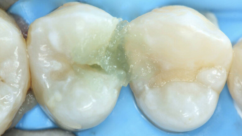 Figuras 21, 22 y 23. Se coloca a través de esa cavidad el agente enzimático Brix3000 para la remoción químico-mecánica.