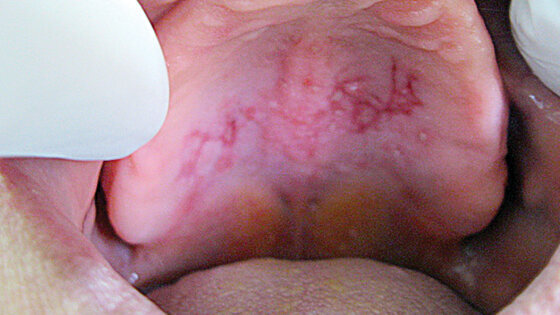 Protetická stomatitida: Ošetření diodovým laserem